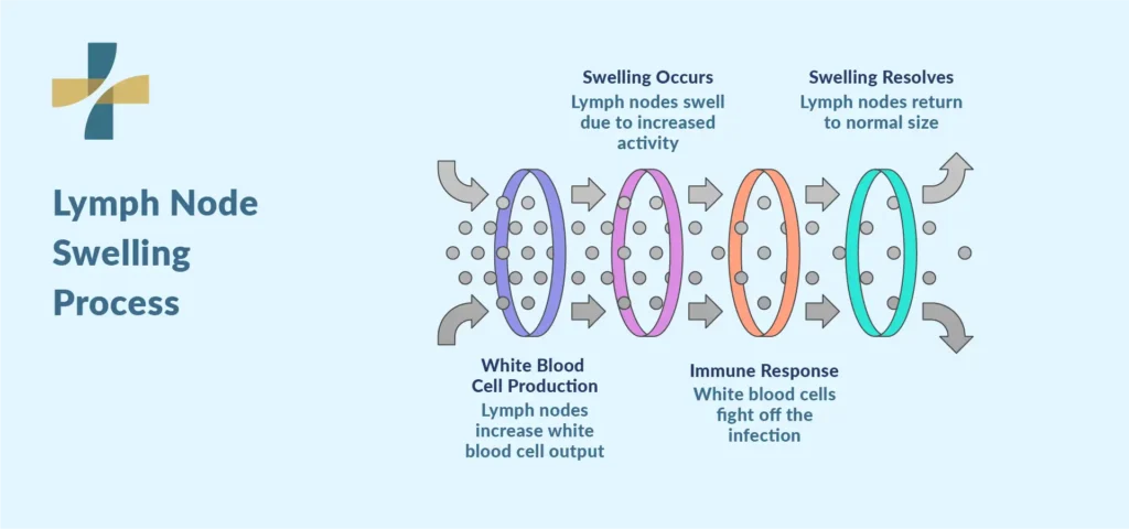 What Are Swollen Lymph Nodes?